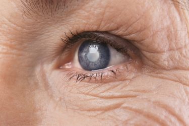 Cataract- Modifiable and Non-modifiable Risk factors